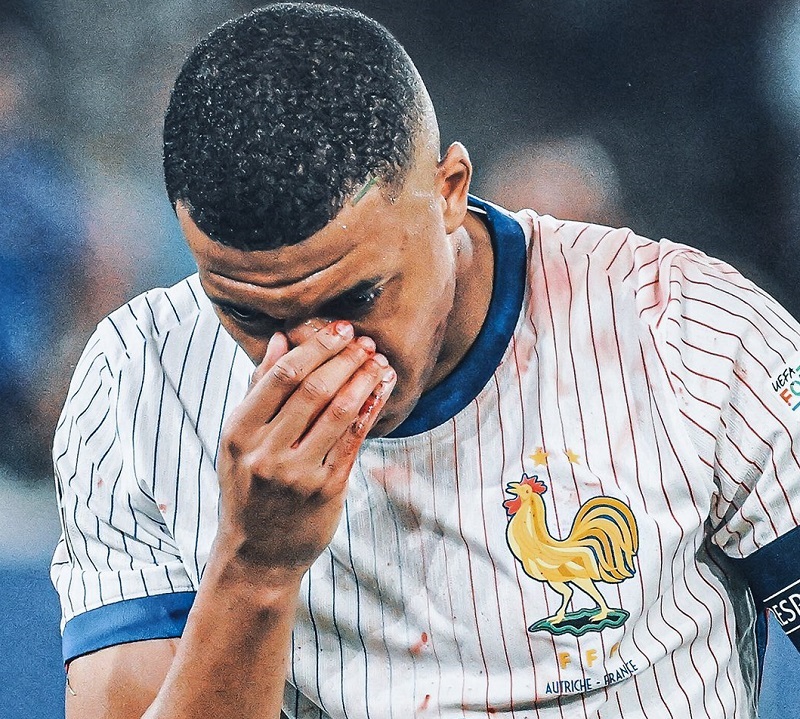 Mbappe alami patah hidung