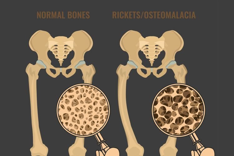 Osteomalasia