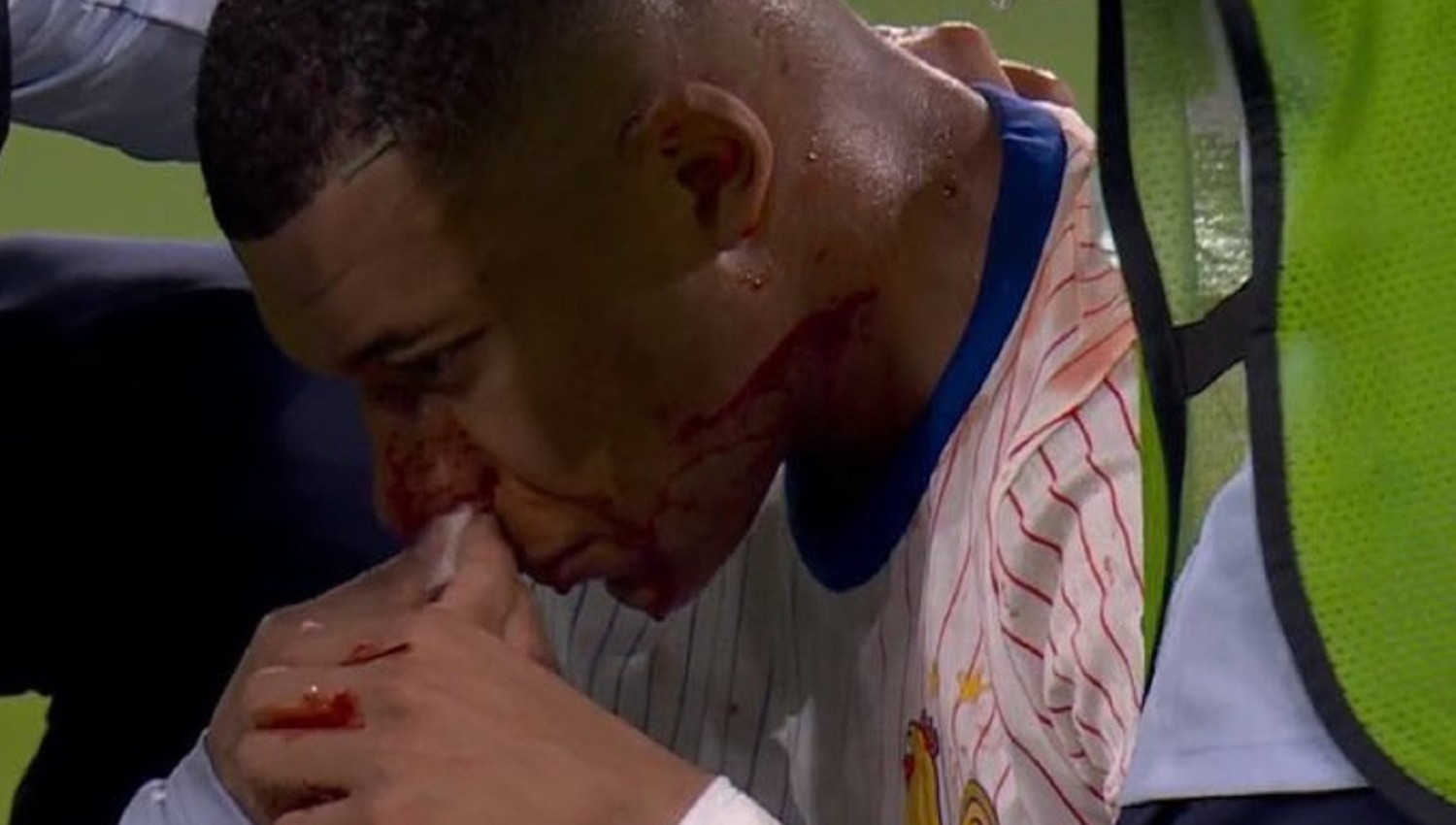 Euro 2024: Mbappe Apes Banget, Gagal Cetak Gol, Hidung Patah Pula